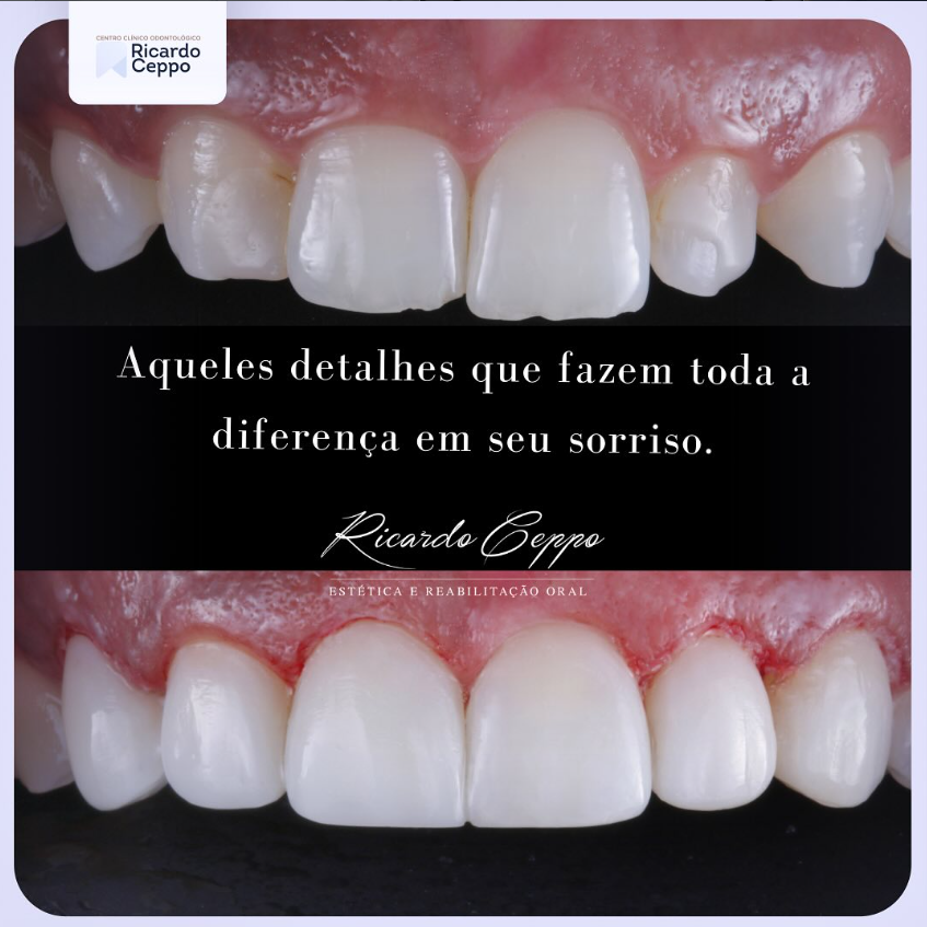 Registro de diagnóstico e de conclusão de tratamento nos dentes anteriores superiores
