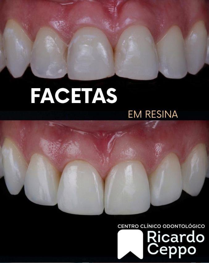 Registro de diagnóstico e de conclusão de tratamento com facetas em resina
