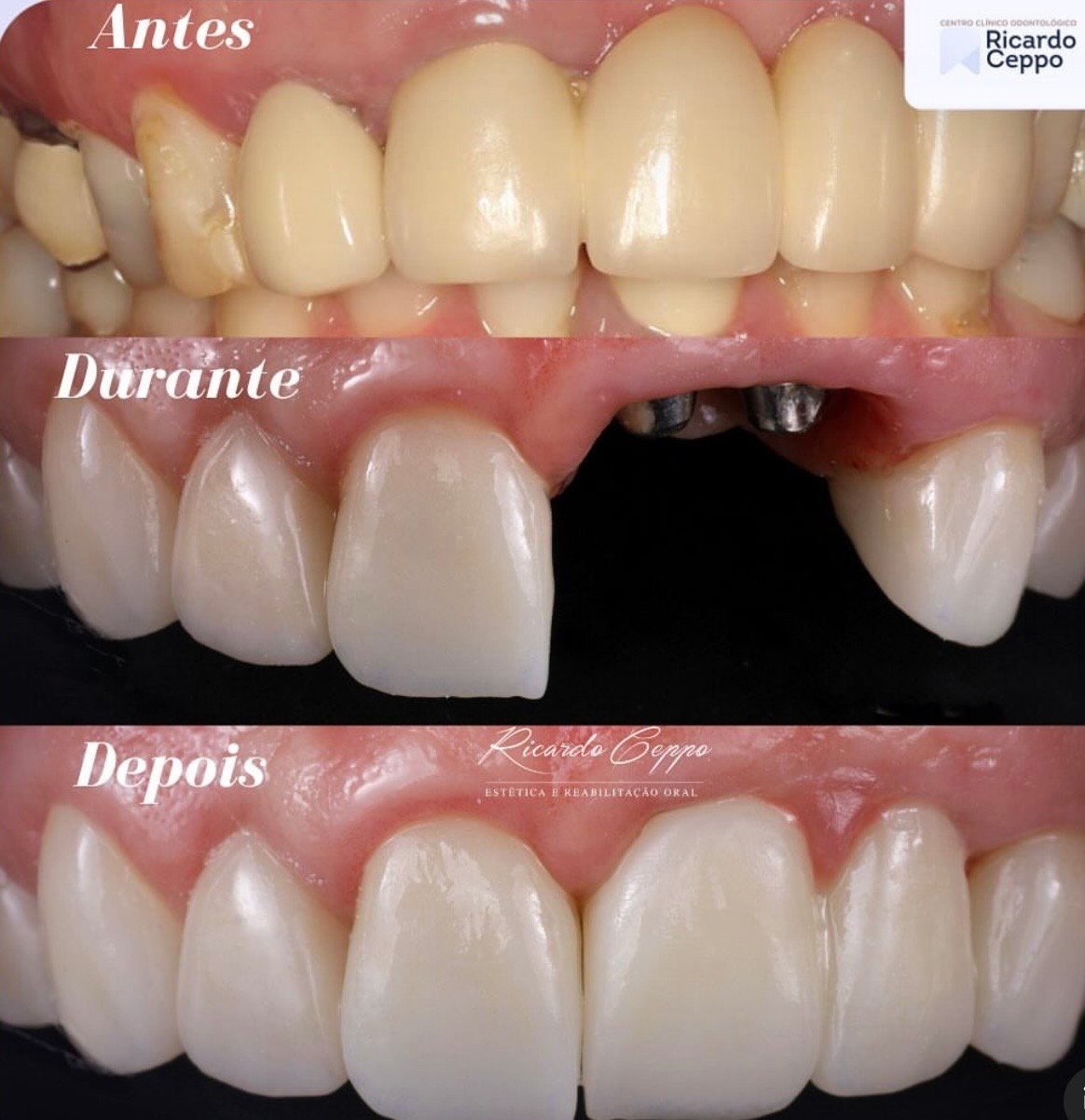 Registro de tratamento com prótese sobre implante nos dentes superiores
